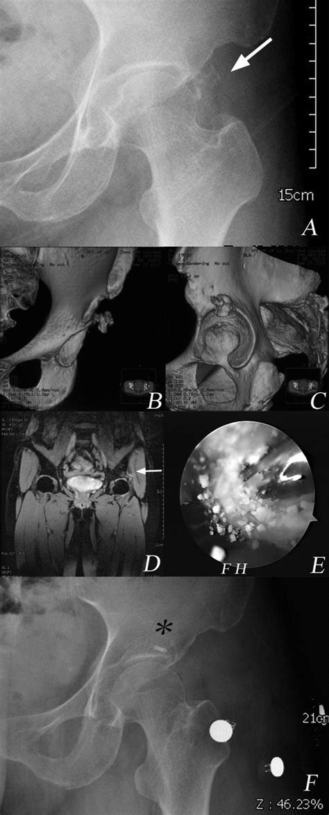 Arthroscopic Treatment Of Chronically Painful Calcific Tendinitis Of