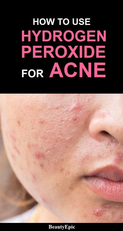 how to use hydrogen peroxide on acne skin body acne acne skin skin care acne acne scars