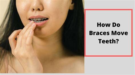 How Do Braces Move Teeth Is It Hurt Teeth