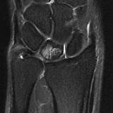 Carpenter Syndrome Radiology Pictures