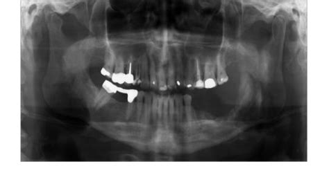 Panoramic Radiograph Showing Osteolysis Due To Osteoradionecrosis Of