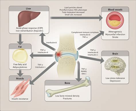 The Pathogenesis Of Rheumatoid Arthritis Nejm