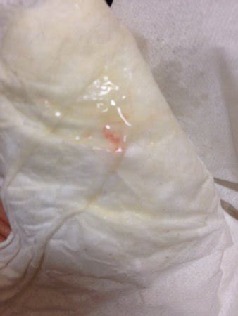 Because white vaginal discharge can sometimes seem like an infection leukorrhea is normal when you're experiencing major changes in hormones like estrogen. *PIC ADDED* Implantation Bleeding - BabyCenter