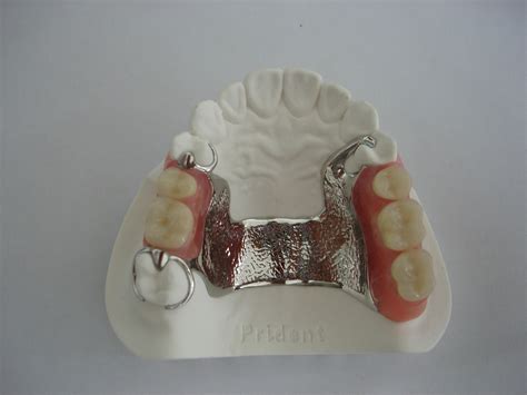 Vitallium 2000 Cast Metal Partial Partial Denture Removable