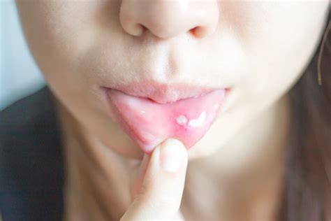 Find Out What The Appearance Of White Spots On Your Lips Indicates