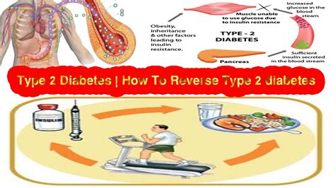 Type 2 Diabetes How To Reverse Type 2 Diabetes Youtube