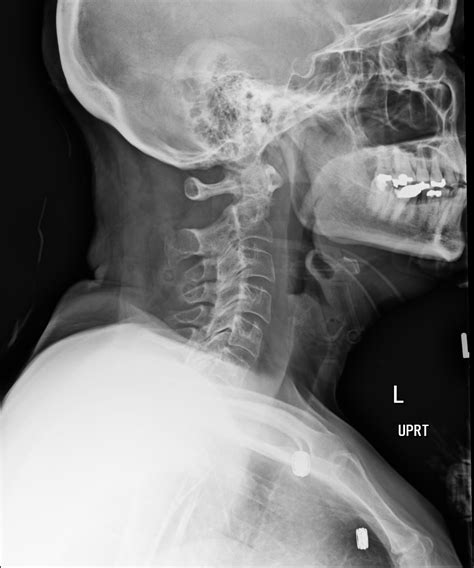Cervical Spine Imaging In Trauma 2022