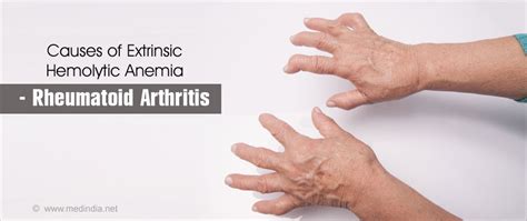 Hemolytic Anemia Causes Symptoms Diagnosis Treatment