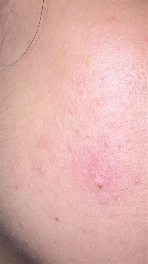 What Are These Tiny White Bumps On My Cheeks More Info In Comments R