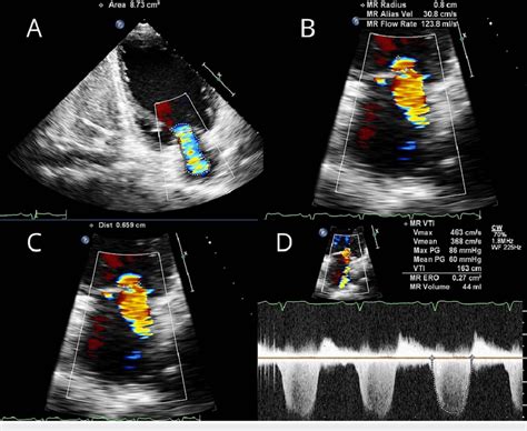 Transthoracic Echocardiogram Of Mitral Regurgitation A Two Chamber Download Scientific