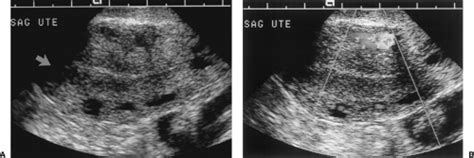 Ultrasound Of Pelvis Female