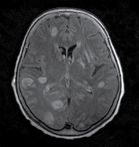Cerebral Toxoplasmosis After Rituximab Therapy Clinical Pharmacy And