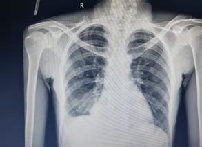 Steroid Sans Chemotherapy In A Case Of Tuberculous Pleural Effusion A