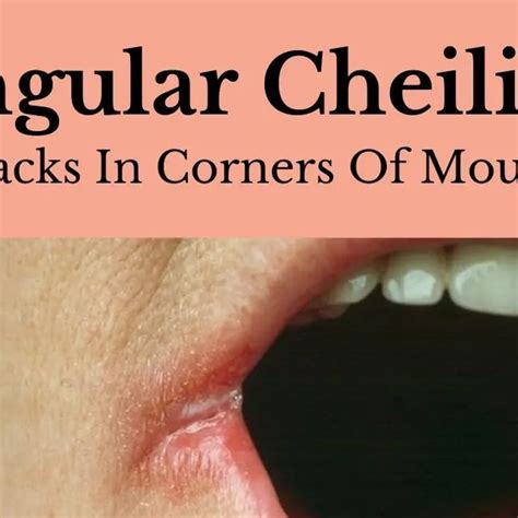 Homoeopathy Academy On Instagram Angular Cheilitis Is Inflammation