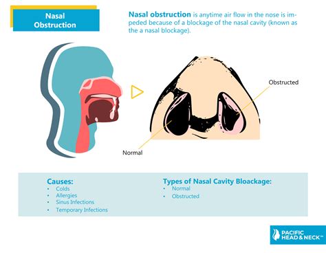 Newborn Nasal Congestion Discount Price Save 43 Jlcatjgobmx