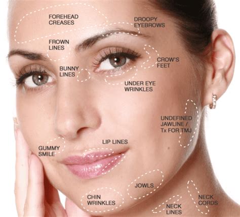 Facial Injectables Learn About Botox And Dermal Fillers Treatments