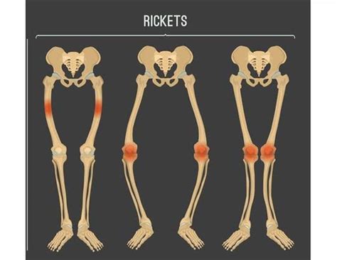 Rickets Medizzy