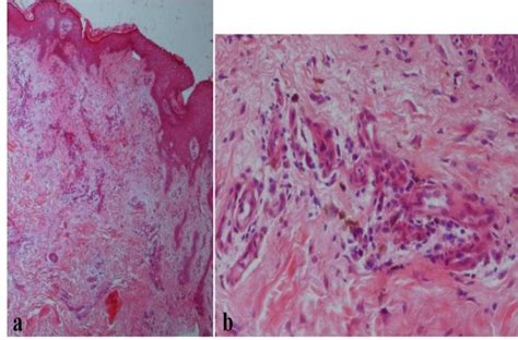 Vacuolar Interface Dermatitis With Necrotic Keratinocytes And A