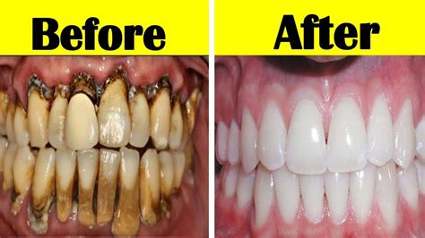 One denture cleaning solution that comes highly recommended from the american dental association is dental bleach. How to Get Rid of Coffee Stains on Teeth | Top 3 Home ...