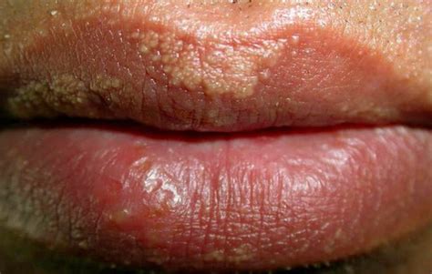 Bumps On Lips Causes Treatments And More Vrogue Co