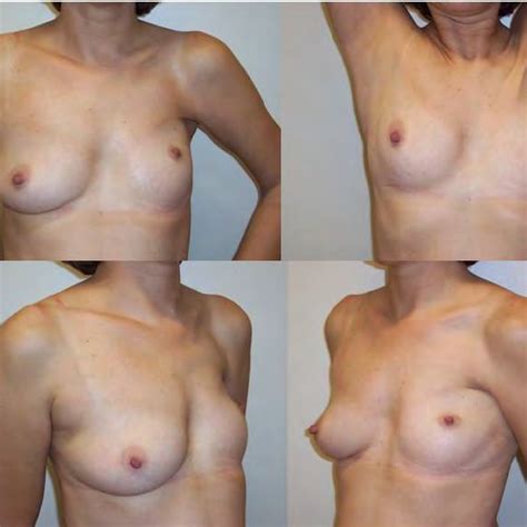 Left Breast Reconstruction With Omentum Flap After Left Mastectomy