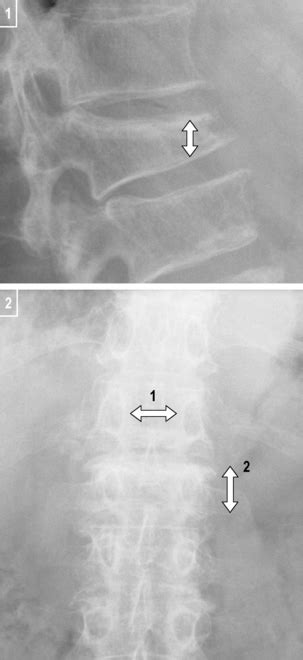 Vertebral Fracture Wedge Compression Radiology Key