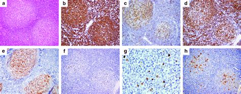 Follicular Lymphoma Grade 3a Follicular Pattern Cd30 Positive