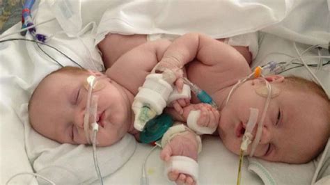 Formerly Conjoined Twins Thriving Released From Hospital