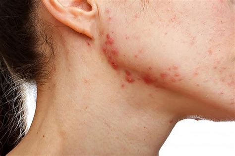 Best Topical Treatments For Acne Scars Livestrongcom