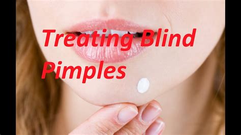 How To Get Rid Of A Blind Pimple Overnight Remove Blind Pimple Youtube