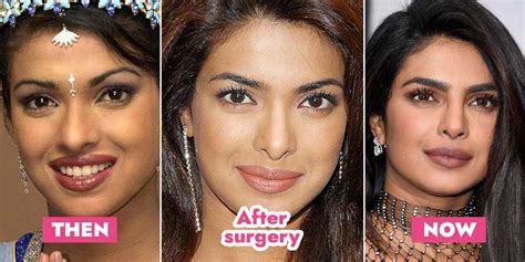 Real Story Behind Priyanka Chopra Controversial Nose Surgery Real Story Behind Priyanka Chopra