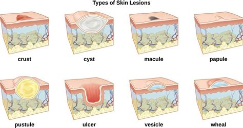 A Skin Lesion Is A Part Of The Skin That Has An Abnormal Growth Or