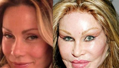 Complete Report On Jocelyn Wildensteins Plastic Surgery Know It All