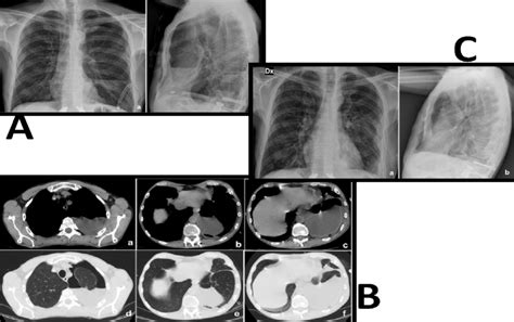 A Chest X Ray Showing A Left Pleural Effusion And A Left Apical