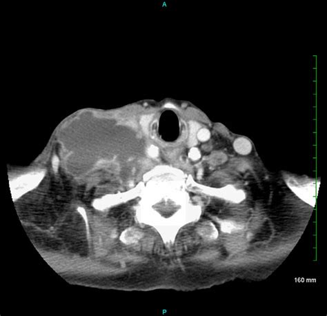 Cervical Tuberculous Lymphadenitis In An Elderly Adult Bmj Case Reports