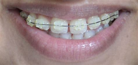 After getting braces, you have to maintain it properly, otherwise, part of the braces may be broken.one of the most common problems during braces treatment is braces wire popped out or come out of the bracket. The Beauty and the Cheap: My Life with Braces: Week 1