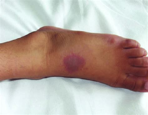 Purplish Macular Skin Rash At The Dorsum Of The Left Foot Indicating