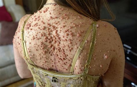 Rare Skin Disease Leaves Woman Covered In Almost 6000 Tumours