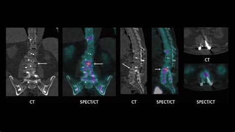 Spectct Imaging In The Evaluation Of Pain Following Spinal Fusion