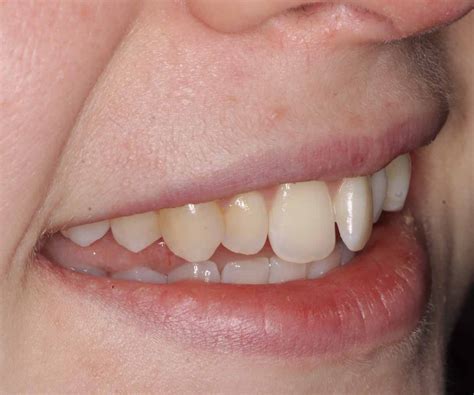 Invisalign And Composite Bonding Case Study Dentist Leeds Fhdc