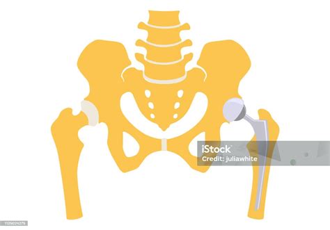 Total Hip Replacement Stock Illustration Download Image Now Hip