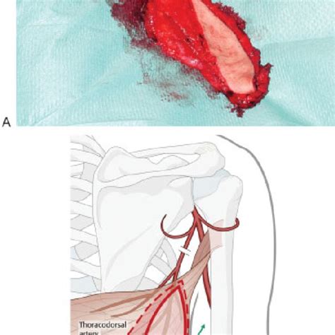 Segmental Mandibular Defect Before Addition Of Latissimus Dorsi