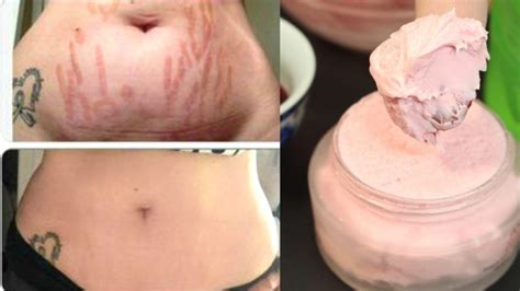 Remove Stretch Marks With This Homemade Cream With Images Stretch