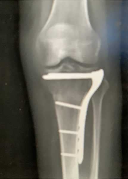 What Is A Lateral Tibial Plateau Fracture