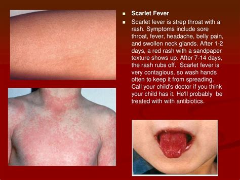 Evaluating A Child With Febrile Rash