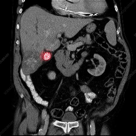 Gallstones Ct Scan Stock Video Clip K0029512 Science Photo Library