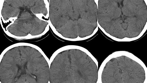 Anoxic Brain Injury Mri Injury Choices