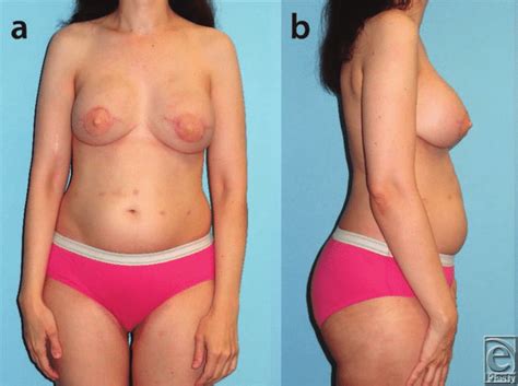 Thirteen Month Postoperative Frontal A And Lateral B Views After