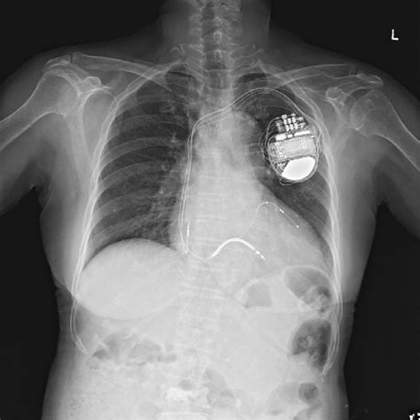 Chest X Ray After Cardiac Resynchronization Therapy With Defibrillator