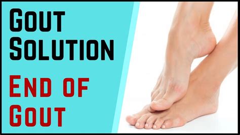Gout Natural Remedy Fast Gout Treatment At Home Youtube